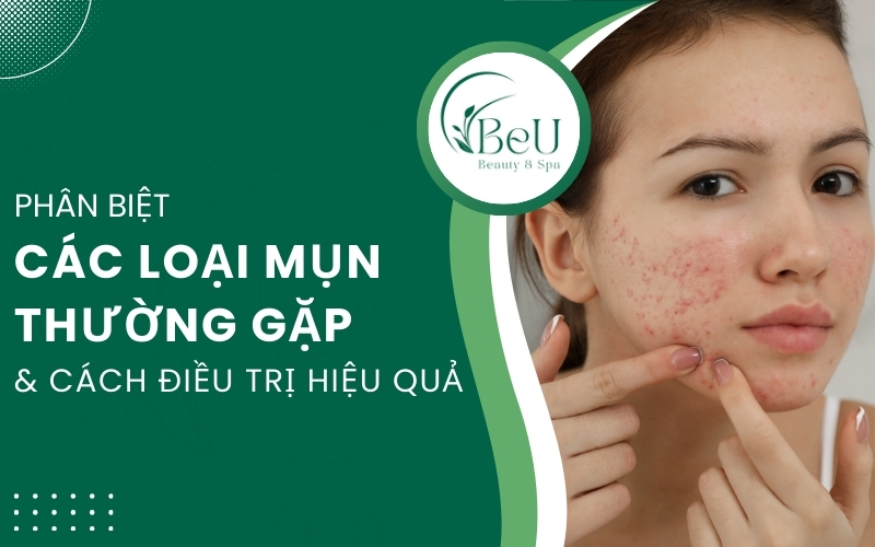 các loại mụn thường gặp