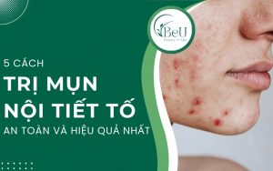 cách trị mụn nội tiết