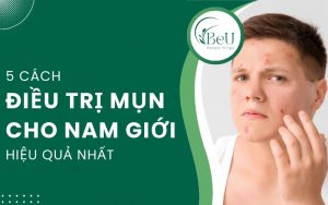 trị mụn cho nam