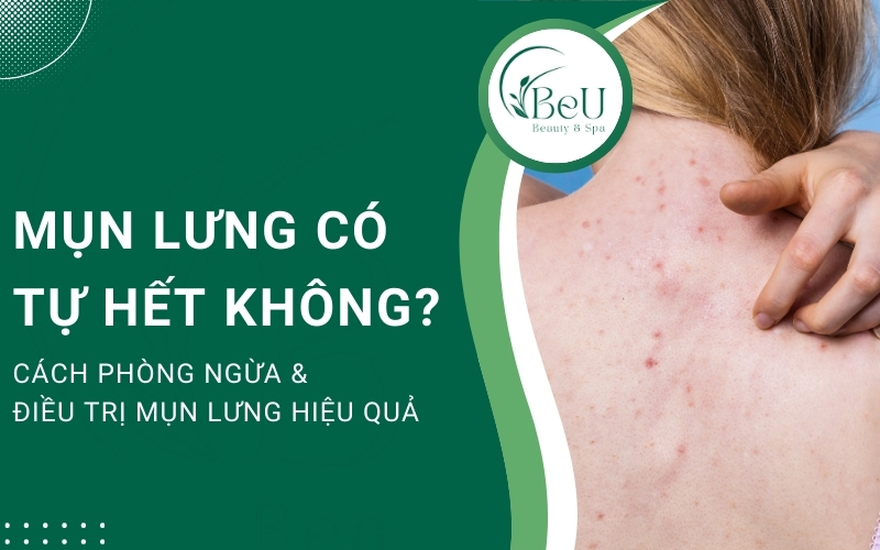 Mụn lưng có tự hết không