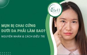 mụn bị chai cứng dưới da phải làm sao