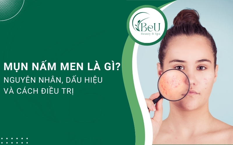 mụn nấm men là gì