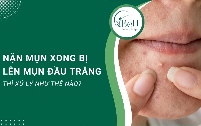 nặn mụn xong bị lên mụn đầu trắng