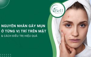 nguyên nhân gây mụn ở từng vị trí trên mặt