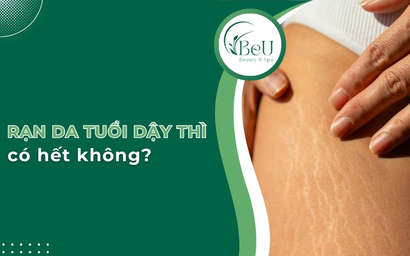 Rạn da tuổi dậy thì có hết không