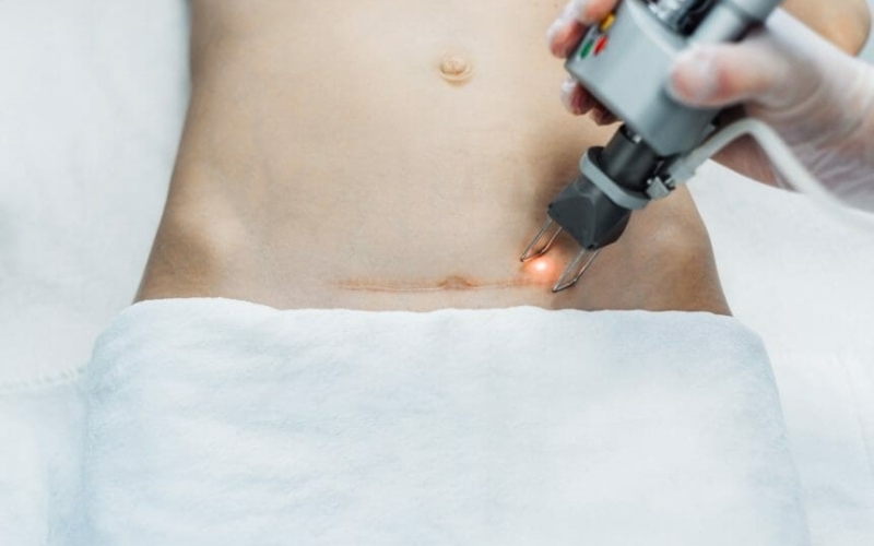 Chi phí trị sẹo lồi bằng laser bao nhiêu tiền