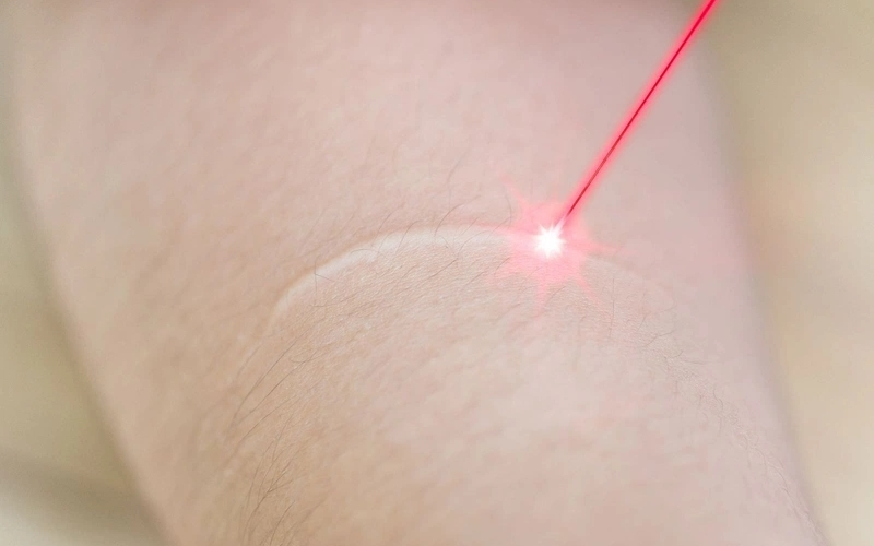 Cơ chế hoạt động của laser trong điều trị sẹo lồi