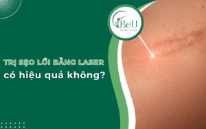 trị sẹo lồi bằng laser có hiệu quả không