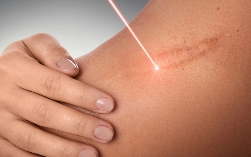 Trị sẹo lồi bằng laser là gì