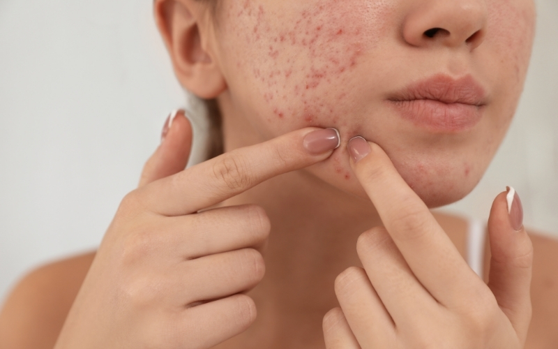Có nên lấy nhân mụn không