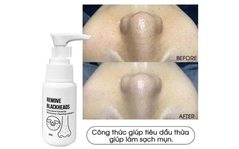 Dùng sản phẩm ủ mụn chuyên dụng