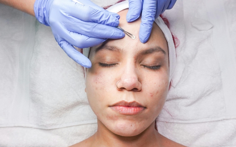 Khi bị mụn có nên nặn mụn không