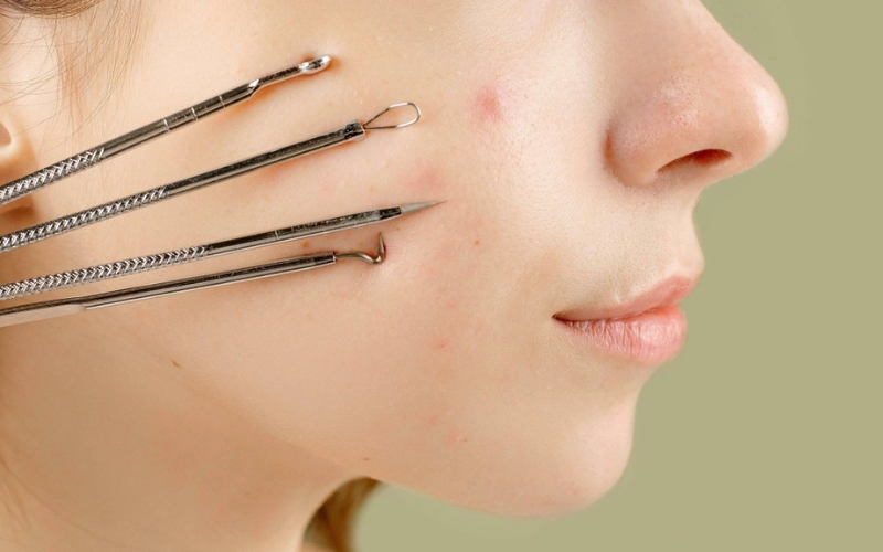 Một số lưu ý quan trọng trong quá trình nặn mụn