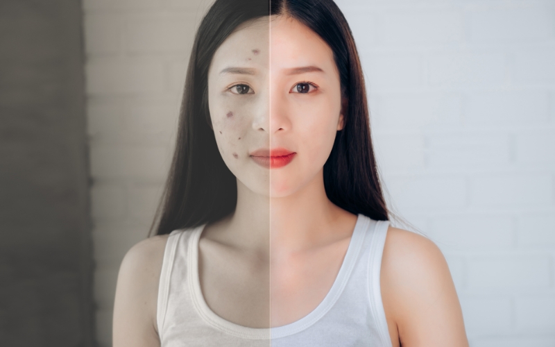 Có thể chữa trị mụn triệt để không