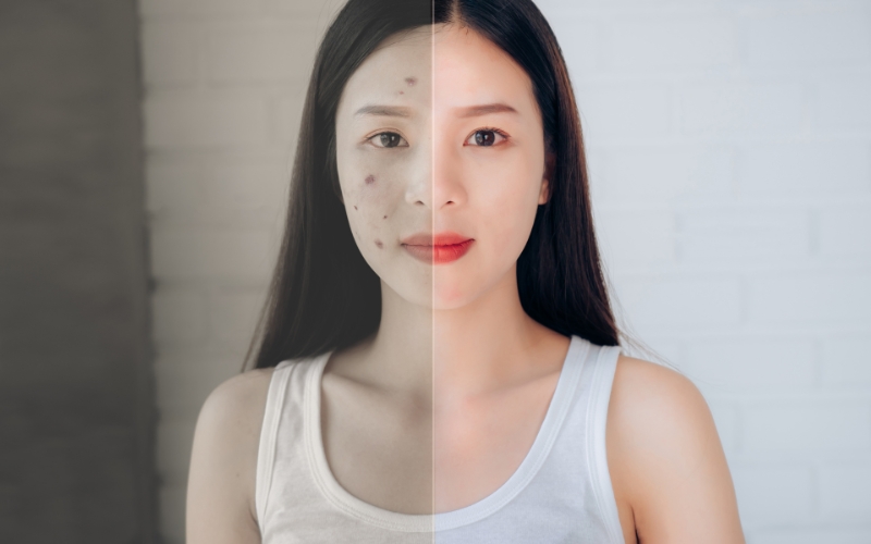 Mụn nổi do kinh nguyệt bao lâu thì hết