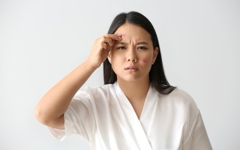 Những nguyên nhân gây nổi mụn trên da