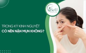 Trong kỳ kinh nguyệt có nên nặn mụn không