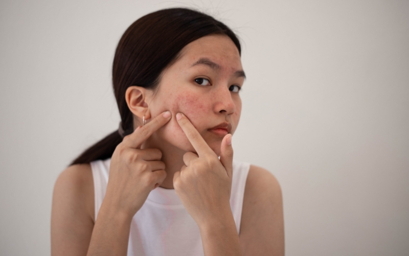 Có nên nặn mụn sẩn không