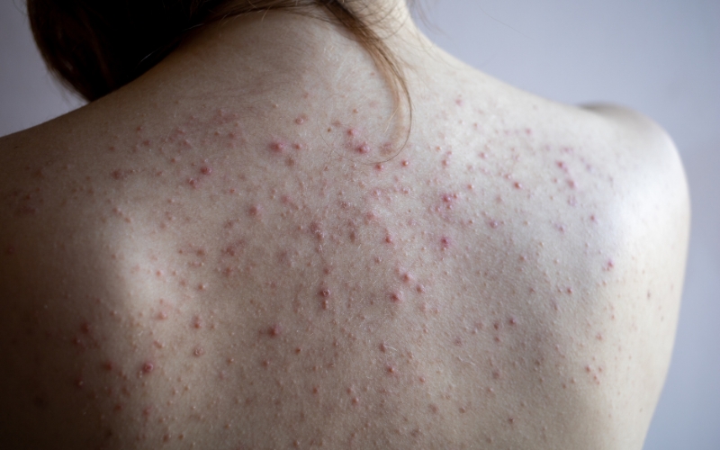 Đối tượng được chỉ định dùng Isotretinoin