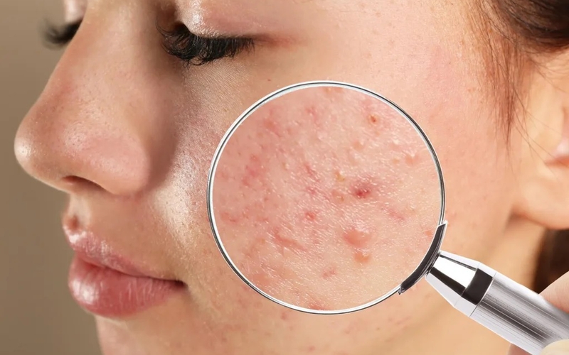 Mụn sẩn có nhân hay không có nhân
