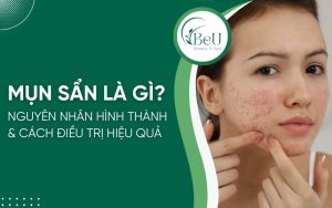 mụn sẩn là gì
