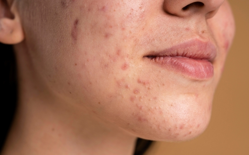 Mụn sẩn ở khu vực cằm