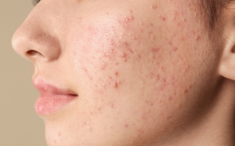 Mụn trứng cá là gì