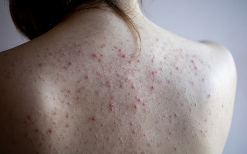 Nguyên nhân gây nổi mụn lưng là gì