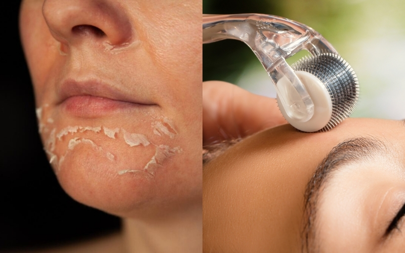 Có nên kết hợp peel da với lăn kim trong một liệu trình điều trị sẹo không