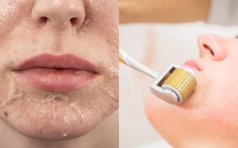 Điểm khác nhau giữa lăn kim và peel da