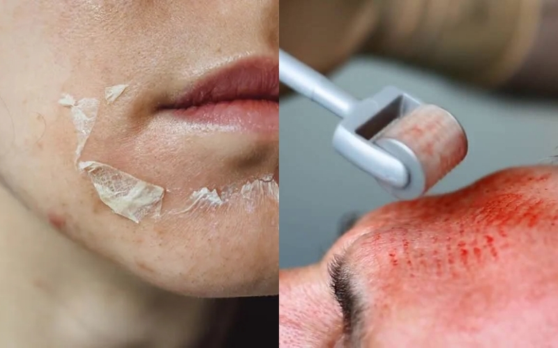Lăn kim vs Peel da: Phương pháp nào điều trị sẹo mụn tốt hơn