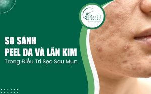 so sánh peel da và lăn kim