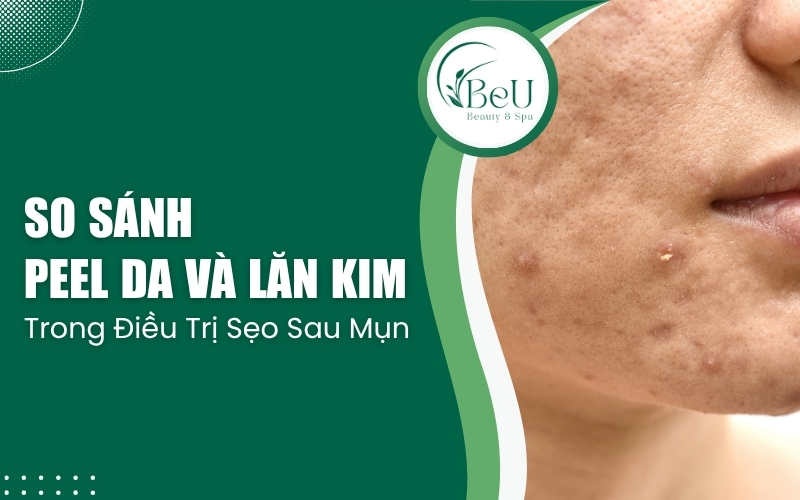 so sánh peel da và lăn kim
