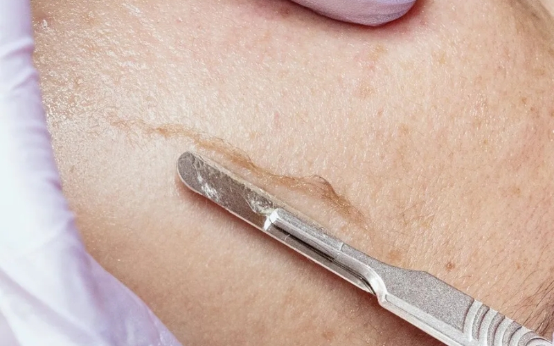 Cách Dermaplaning hoạt động