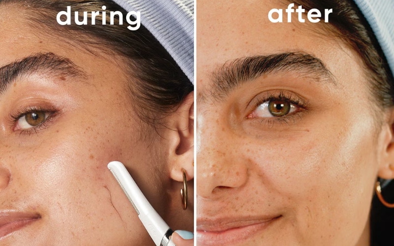 Ưu điểm của Dermaplaning