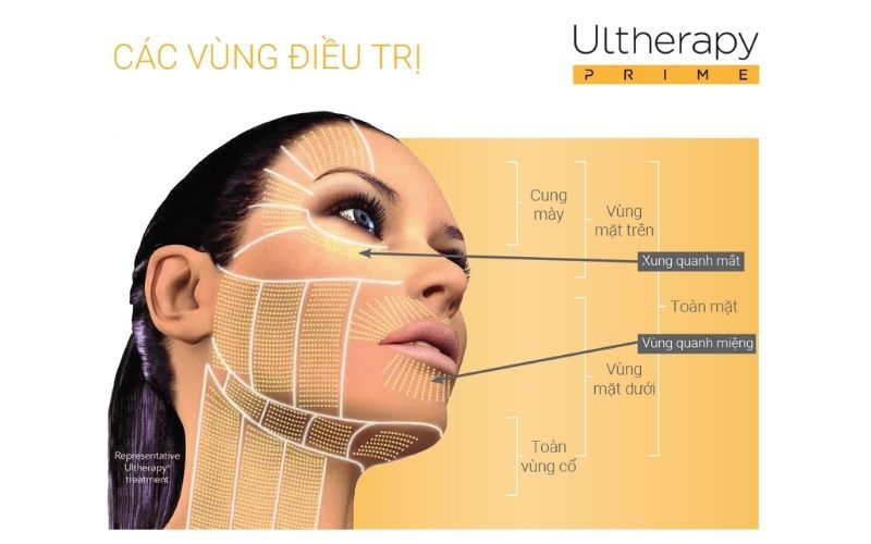 Các vùng da thích hợp điều trị bằng công nghệ Ultherapy Prime