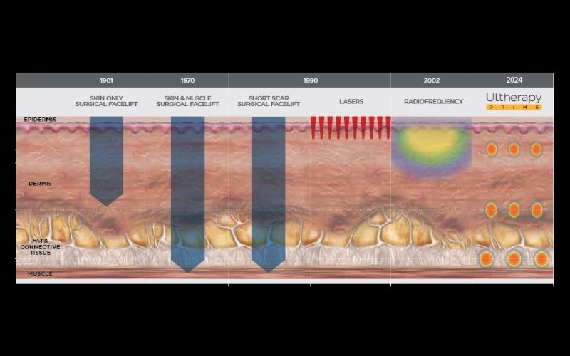 Cơ chế hoạt động của Ultherapy Prime