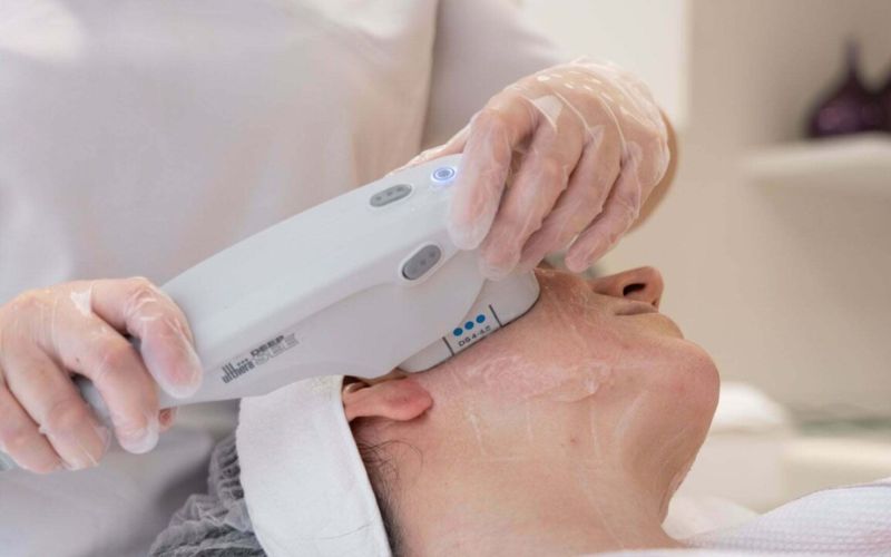 Có nên làm Ultherapy Prime nếu da chưa bị lão hoá không