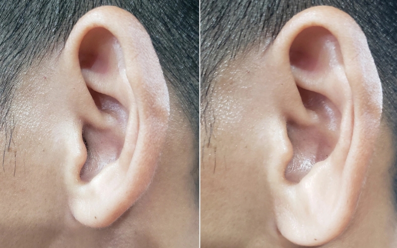 Đối tượng nên tiêm tai tài lộc