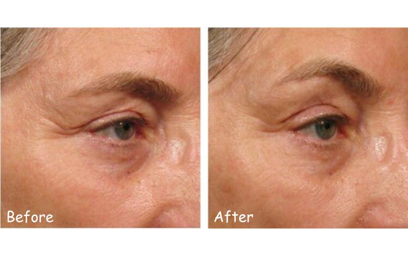 Điều trị nâng cung chân mày với Ultherapy Prime