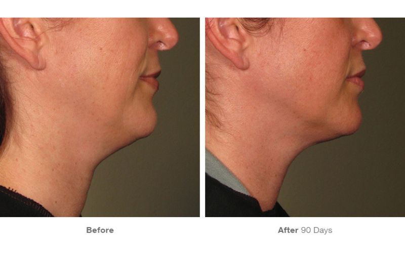 Điều trị nọng cằm với Ultherapy Prime