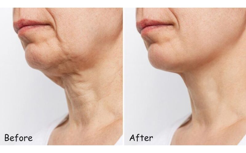 Điều trị nếp nhăn vùng cổ với Ultherapy Prime