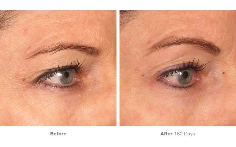 Điều trị vết chân chim và mí sụp với Ultherapy Prime