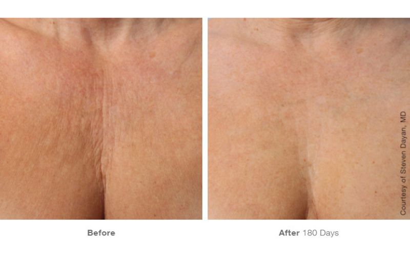 Điều trị nếp nhăn mảnh vùng ngực với Ultherapy Prime