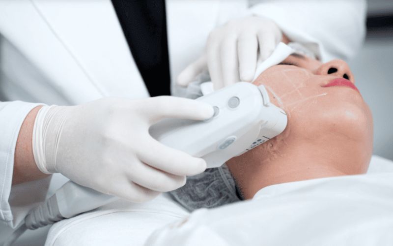 Những lưu ý quan trọng trong liệu trình điều trị Ultherapy Prime